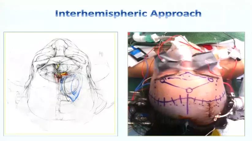 INC巴特朗菲教授视频|视神经-下丘脑胶质瘤全切案例集及治疗解读