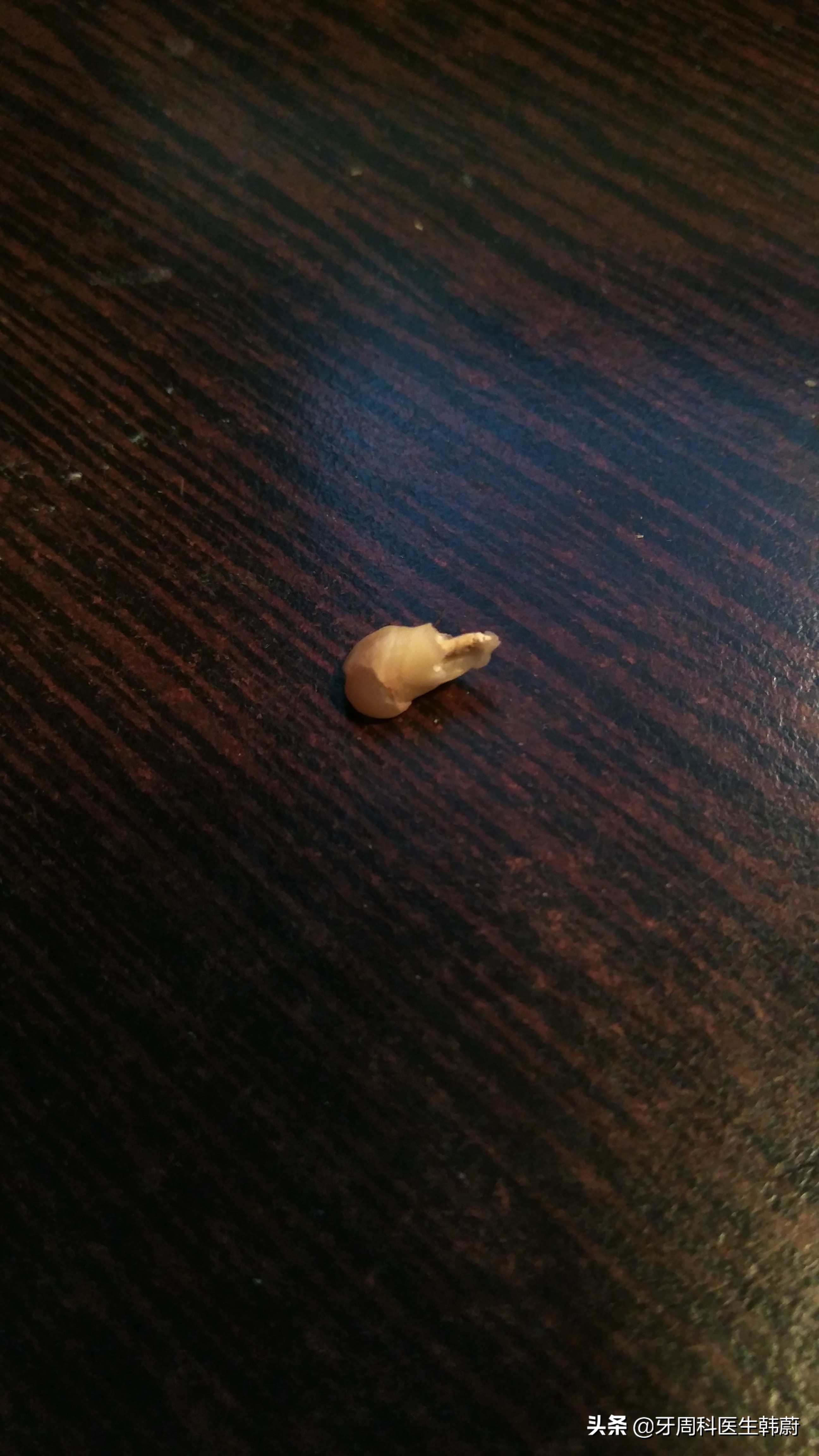 宝宝长双层牙乳牙怎么拔掉,6岁小孩长双层牙必须拔掉吗