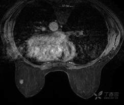 乳腺结节有消散的病例吗,一份完整的乳腺增生病例