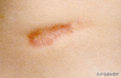 身上有个肿瘤要切除吗,怀疑其他部位有肿瘤需要怎么检查