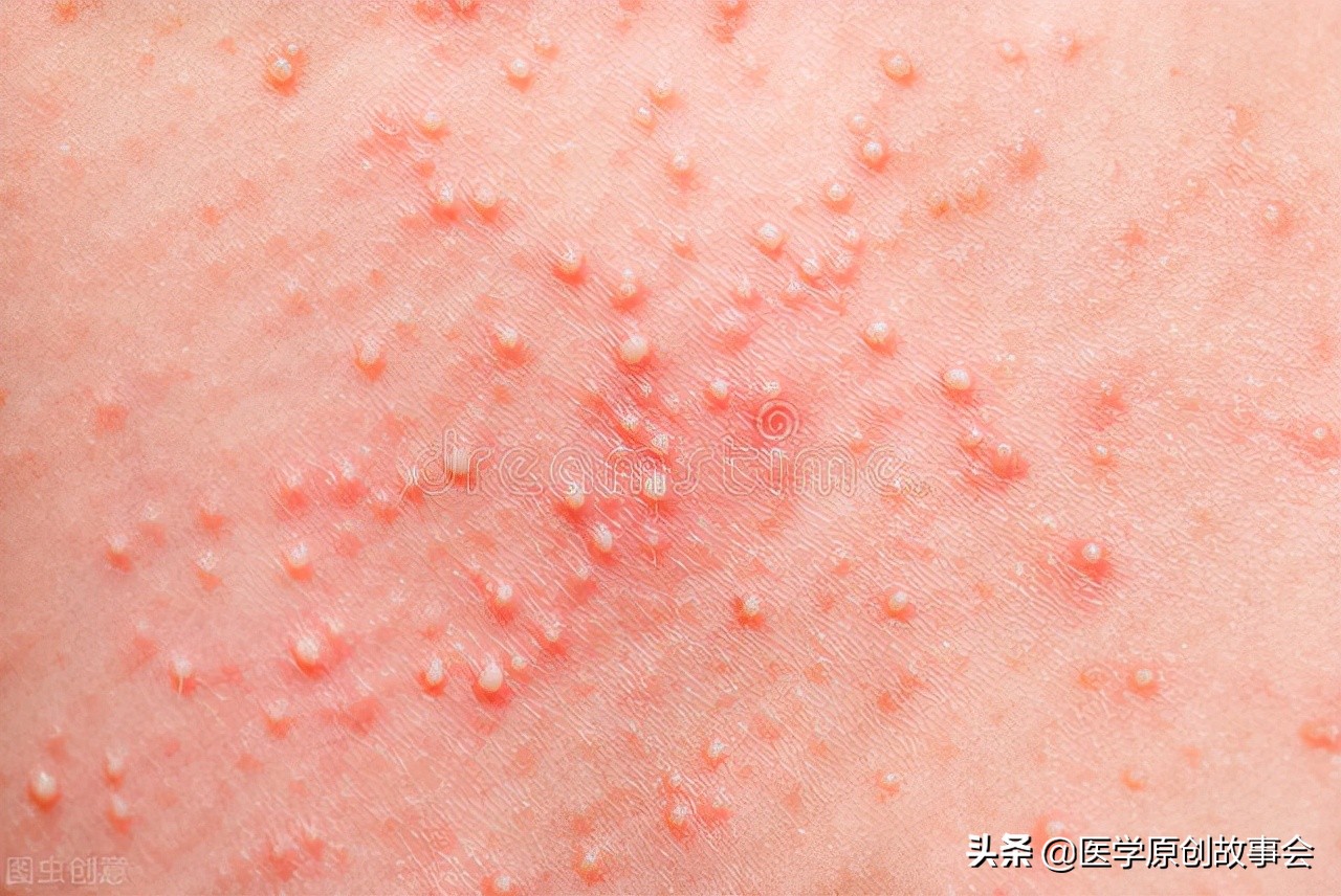 皮肤上长出一个个小肉球是怎么回事，可以抠掉吗？如何处理？