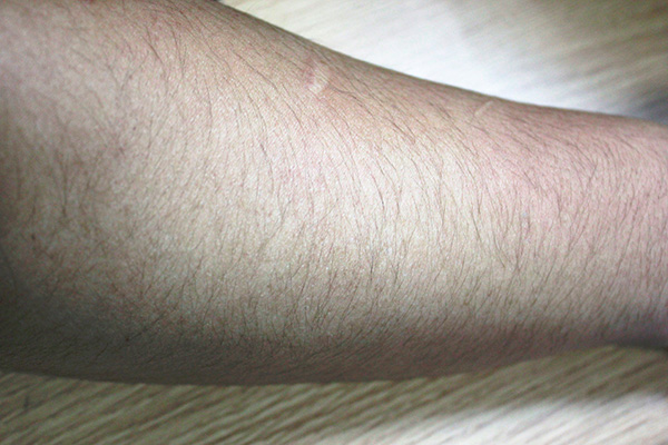 女生汗毛很多的话该如何处理,女生汗毛脱毛后会更长吗