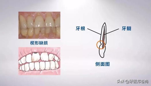 牙齿楔形磨损能修复吗,牙齿楔形损伤是什么意思