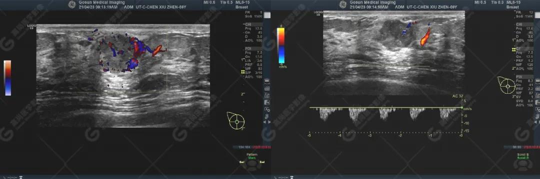 乳腺癌肿瘤科普,乳腺癌结节科普