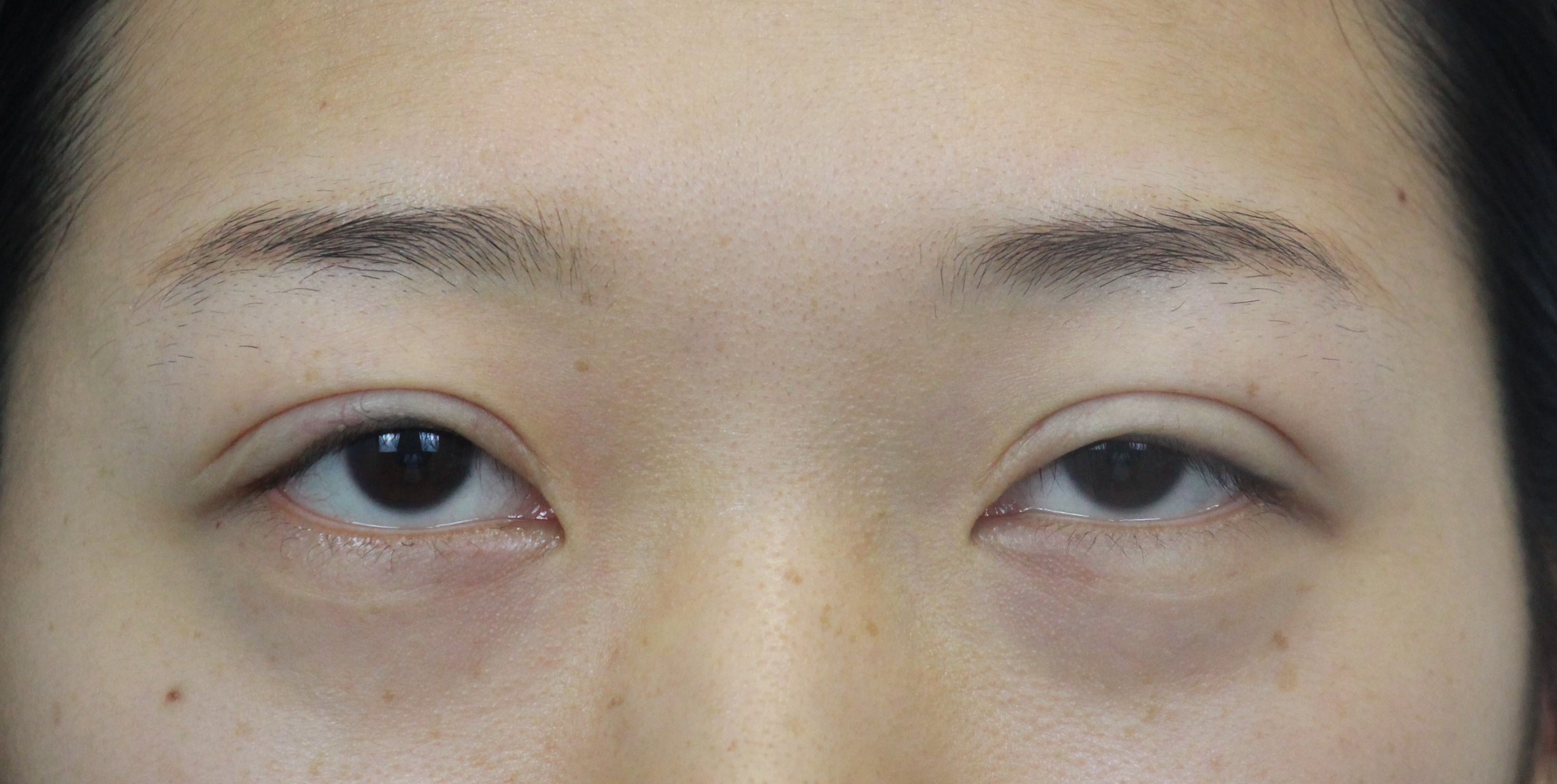 女子双眼皮术后大小眼,大小眼做了双眼皮感觉眼角不对称