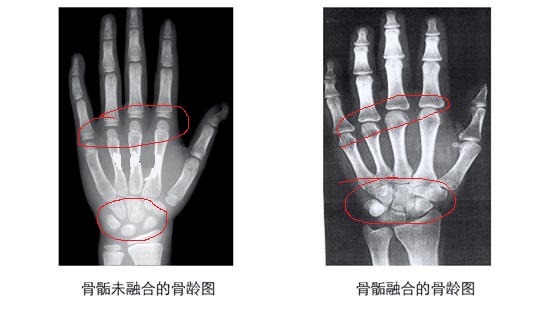 儿童身高矮小检查骨龄,健康科普儿童骨龄片之5问5答
