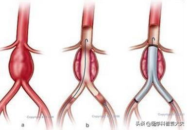 上消化道出血的五种常见病因,双氯芬酸钠引起消化道出血的原因
