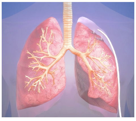 术后咳嗽感觉肺漏气,肺部穿刺后肺漏气多久愈合