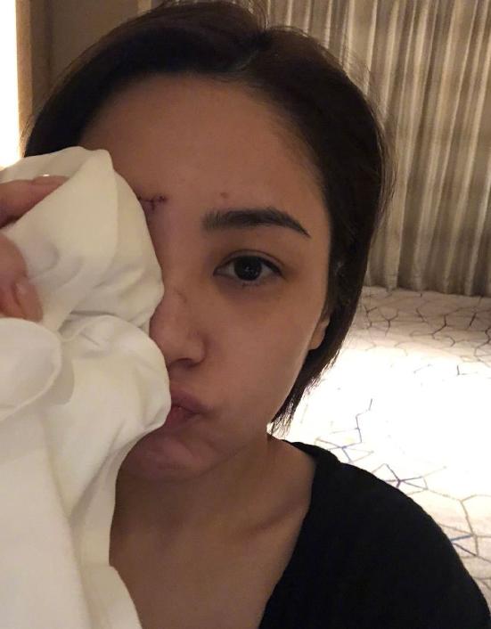 医美专家爆阿娇6㎝伤口肯定留疤痕,激光也难以恢复平滑肌肤