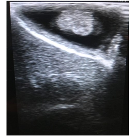 胆囊息肉手术多少钱,发现胆囊息肉怎么办