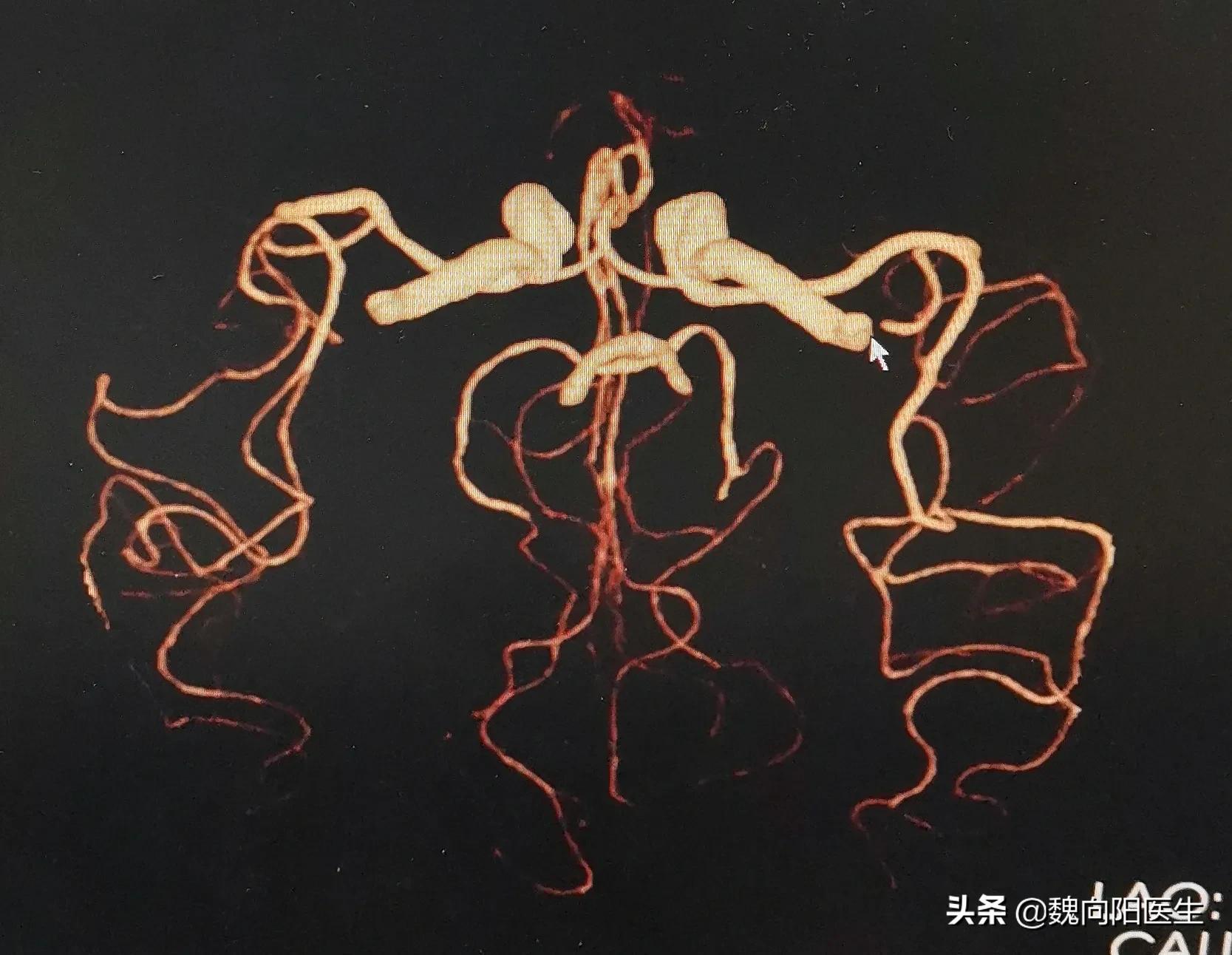 年纪轻轻得脑梗是什么原因,年纪轻轻就脑梗