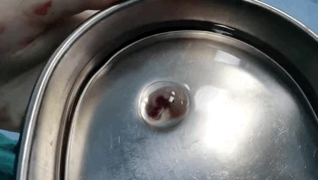 月经淋漓不尽突然大出血啥原因,月经淋漓不尽还腹痛腹胀是什么病