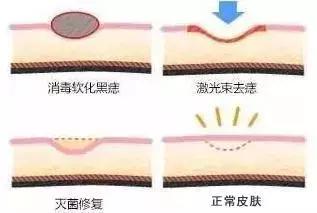 医生推荐祛痣,医生我想开点药