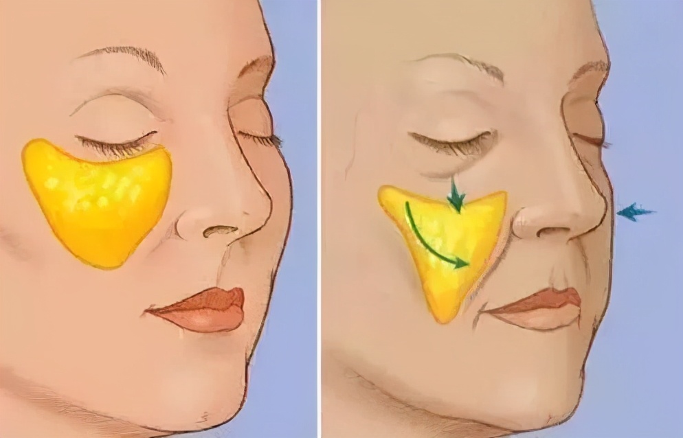 法令纹是什么怎么改善,为什么会有法令纹怎样才能消除