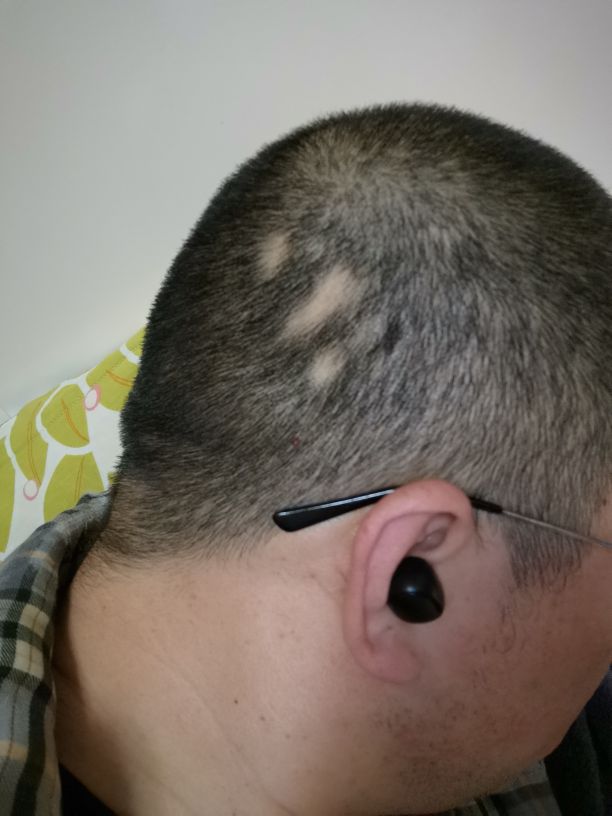 发现斑秃刚好又开始掉头发怎么办,突然发现斑秃怎么治疗