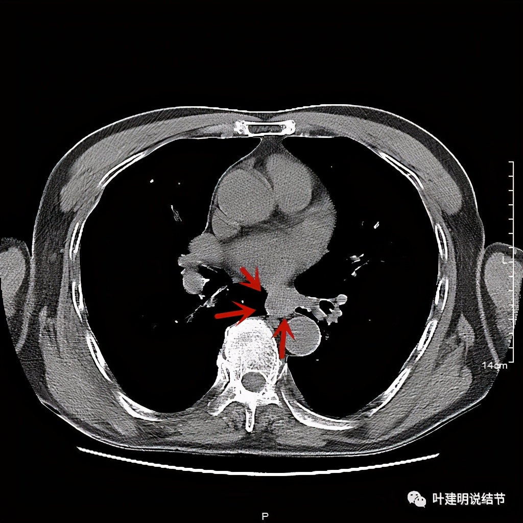 同时发现结肠癌和肺癌怎么处理,同时患结肠癌和直肠癌怎么办