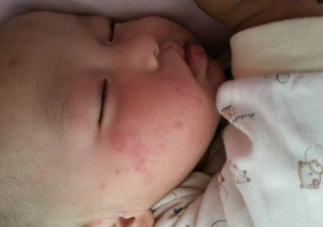 宝宝湿疹结痂的最佳治疗方法,婴儿湿疹结痂又破了怎么办