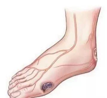 糖尿病下肢溃疡用什么药,糖尿病引起的下肢疼痛有什么危险