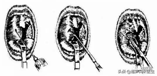 咽喉疾病科普知识,咽喉疾病动画科普视频