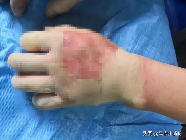 再次发生！2例！酒精消毒引发严重烧伤，关键时刻这样自救！