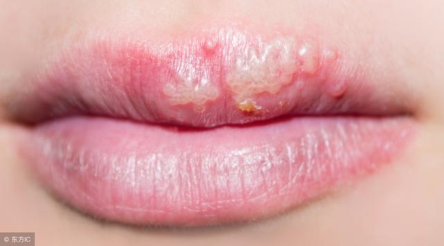 治疗口腔疱疹病毒的药,备孕期感染风疹病毒怎么办