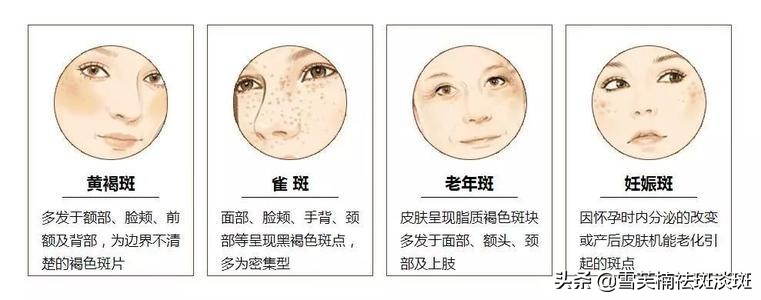 怎么祛斑美白最有效,怎么祛斑美白效果好又快呢