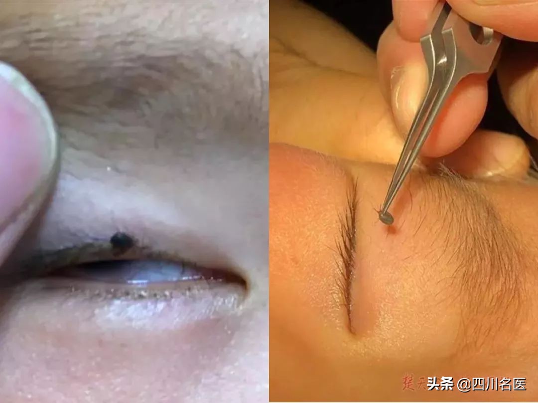 夺命虫被人咬死,儿童被隐翅虫咬死