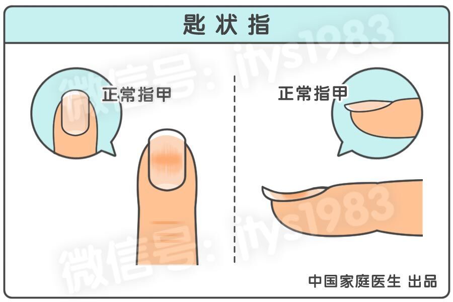指甲上月牙少是什么问题,指甲月牙少了怎么回事
