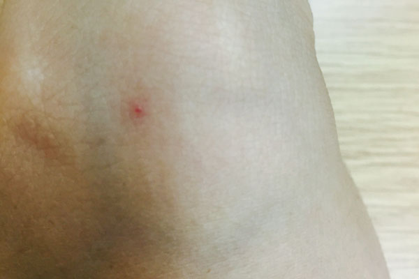 身上突然出现小红痣是什么原因,身体出现许多小红痣是什么原因