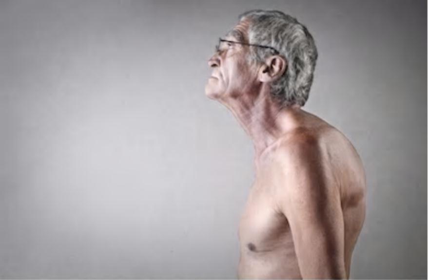 驼背是用什么查的,驼背有什么样子