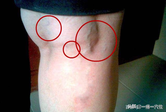 老年足跟痛的治疗方法,老年人足跟痛一招教你解决