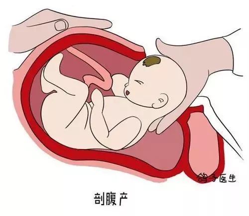 剖腹产的孩子容易感统失调吗,剖腹产的孩子需要做感统训练吗