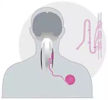 下肢截瘫康复成功案例,全国治疗截瘫最新突破