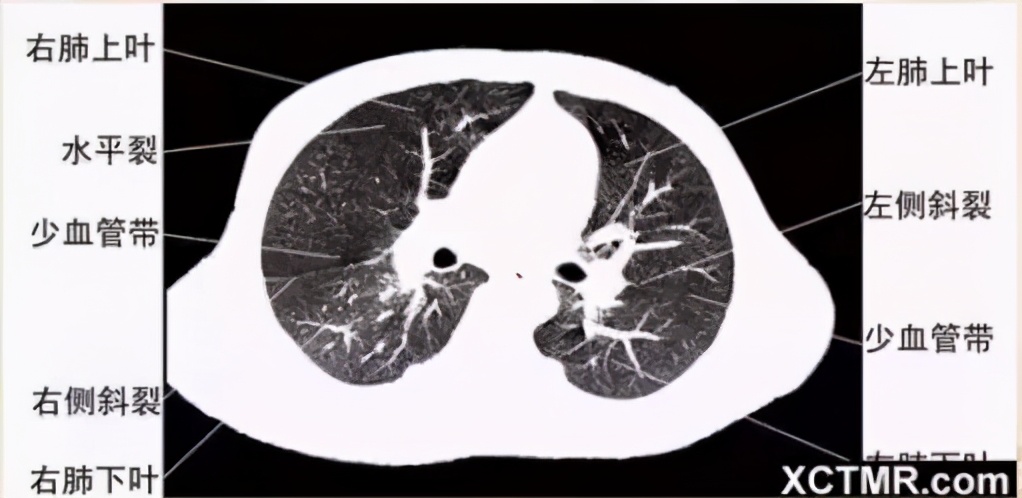 女性盆腔ct断层解剖结构图,女性盆腔脏器ct解剖