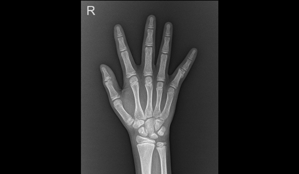 打篮球把手指戳伤了怎么复位,打篮球手指戳伤怎么处理