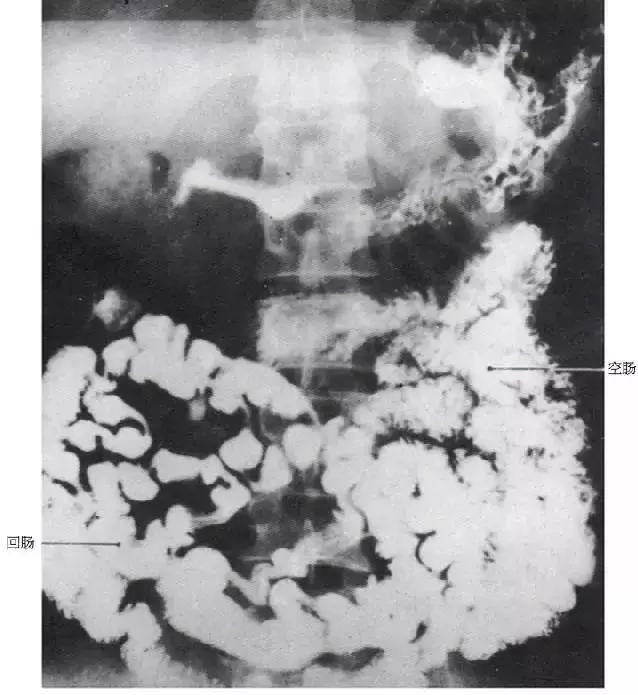 「收藏」11种消化道造影解剖图谱