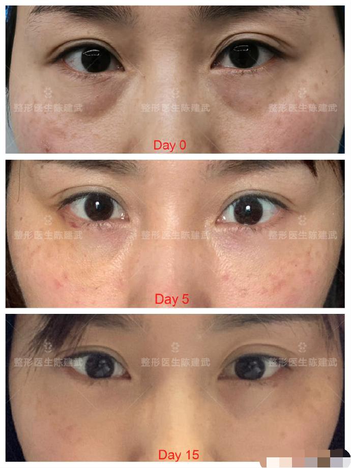 去眼袋术后出现细纹怎样修复,眼袋手术后细纹增加怎么办