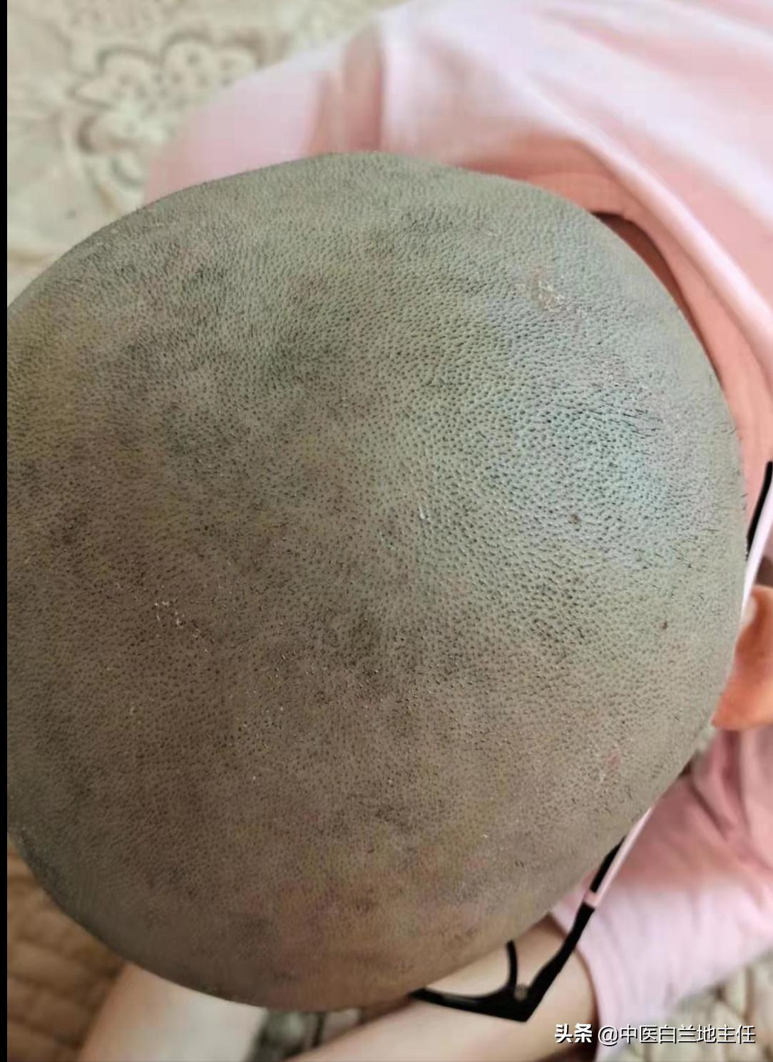 「病例分享」5岁小男孩头部银屑病终好转