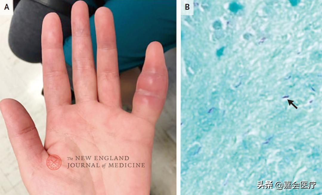 妻子左手小指头肿胀，竟是丈夫外出旅行导致的？