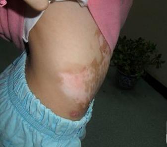 治白，从肠胃做起：10岁女儿白癜风痊愈，是妈妈的一个秘密