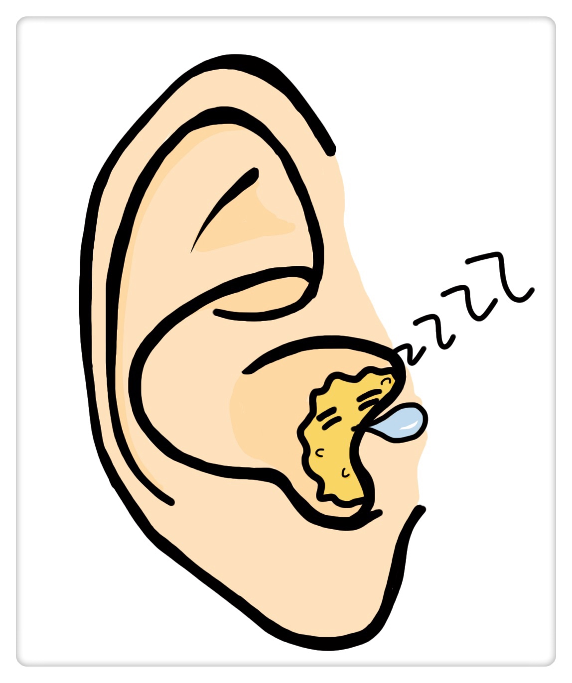 四岁男孩掏耳屎引发颅内感染,掏耳屎竟然导致颅内感染