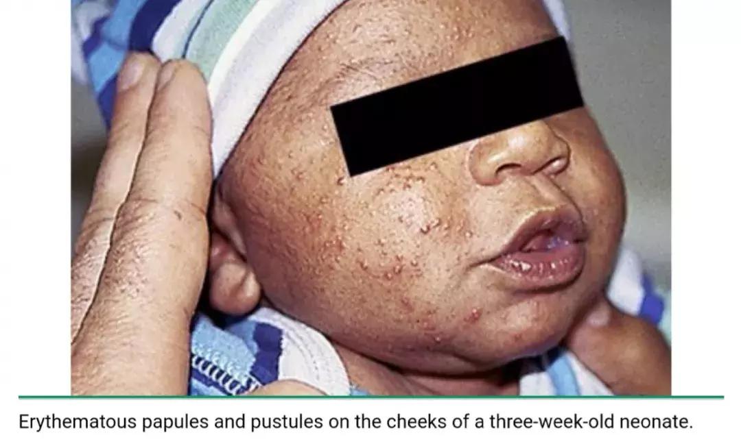 新生儿皮肤问题大全一览表,新生儿常见八大皮肤问题