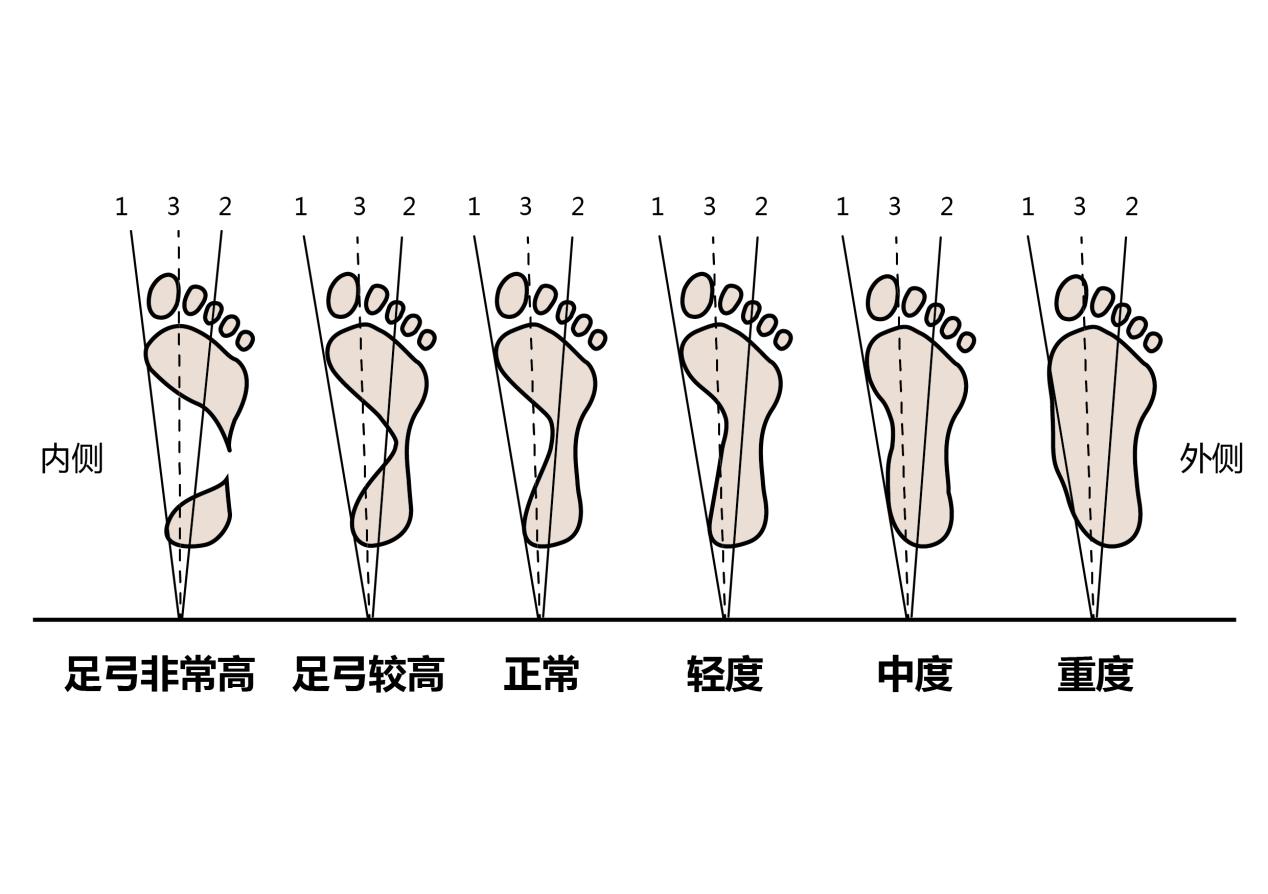 脚后跟痛的病因,脚后跟疼痛预示疾病发生
