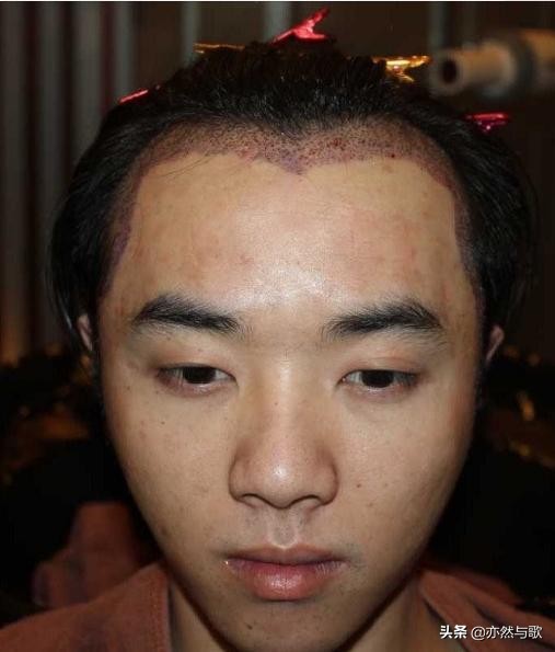 网友晒华晨宇私密视频，曝料其整容植发照，怒骂张碧晨是小三