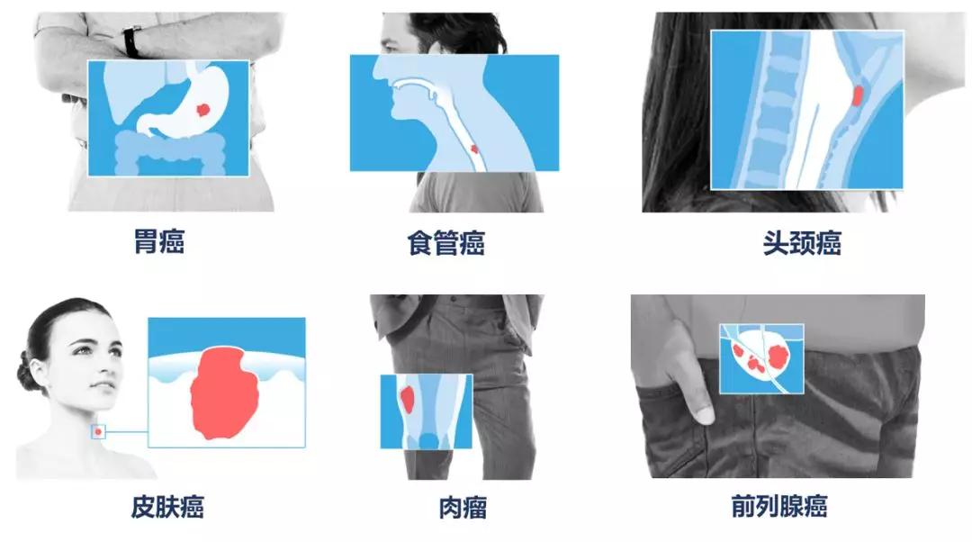 最新科研进展nk免疫细胞治疗癌症,抗癌药物组合物