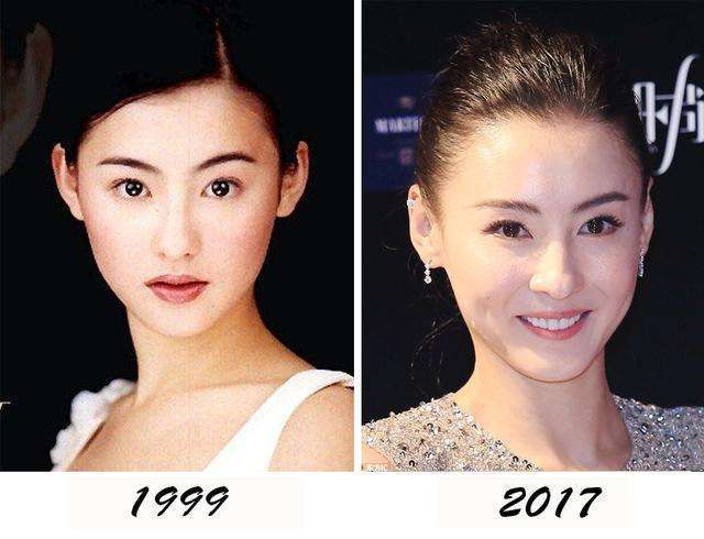 法令纹填充玻尿酸显老,玻尿酸填充法令纹显老怎么办