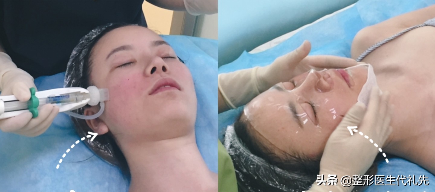 打美白水光针几次可以看到效果,水光针用哪种针注射好