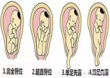 胎儿臀位最晚什么时候能转为头位,胎儿头位和横位有什么区别