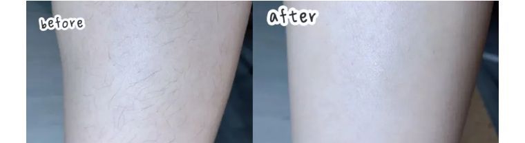 j-style冰点脱毛仪,j-style光子嫩肤脱毛仪