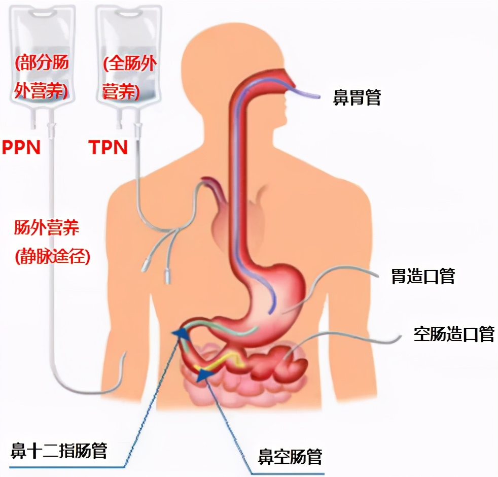 营养支持有哪些？肠内VS肠外如何选择？